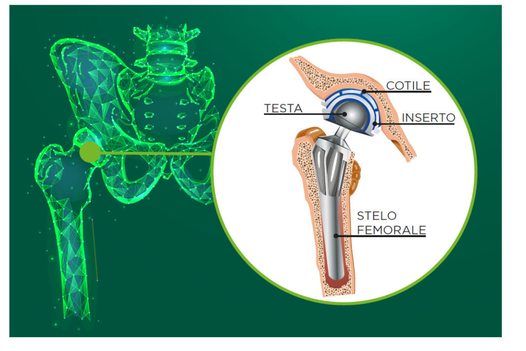 Infografica - Protesi anca