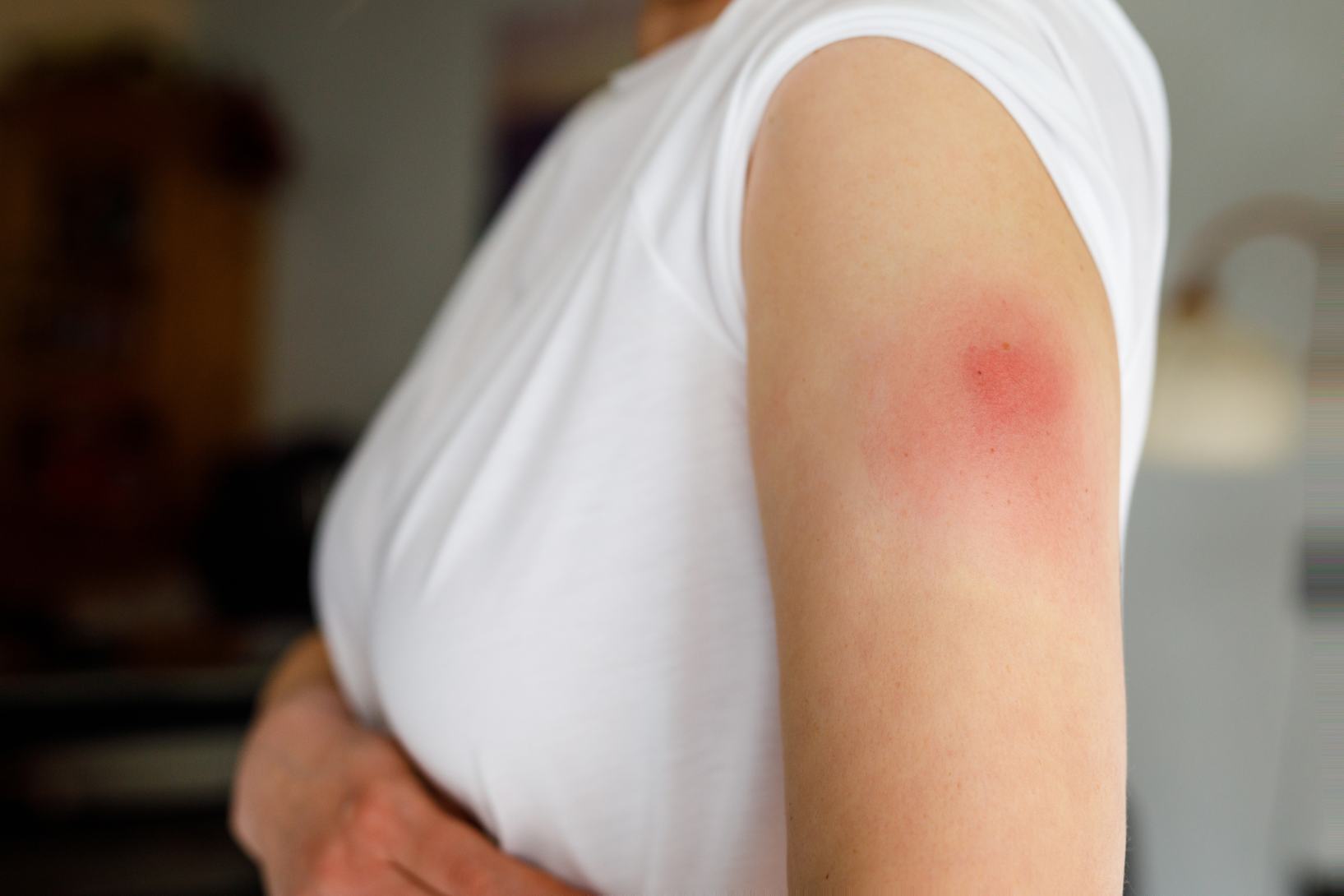 Dermatite allergica da contatto: 4 consigli per combatterla