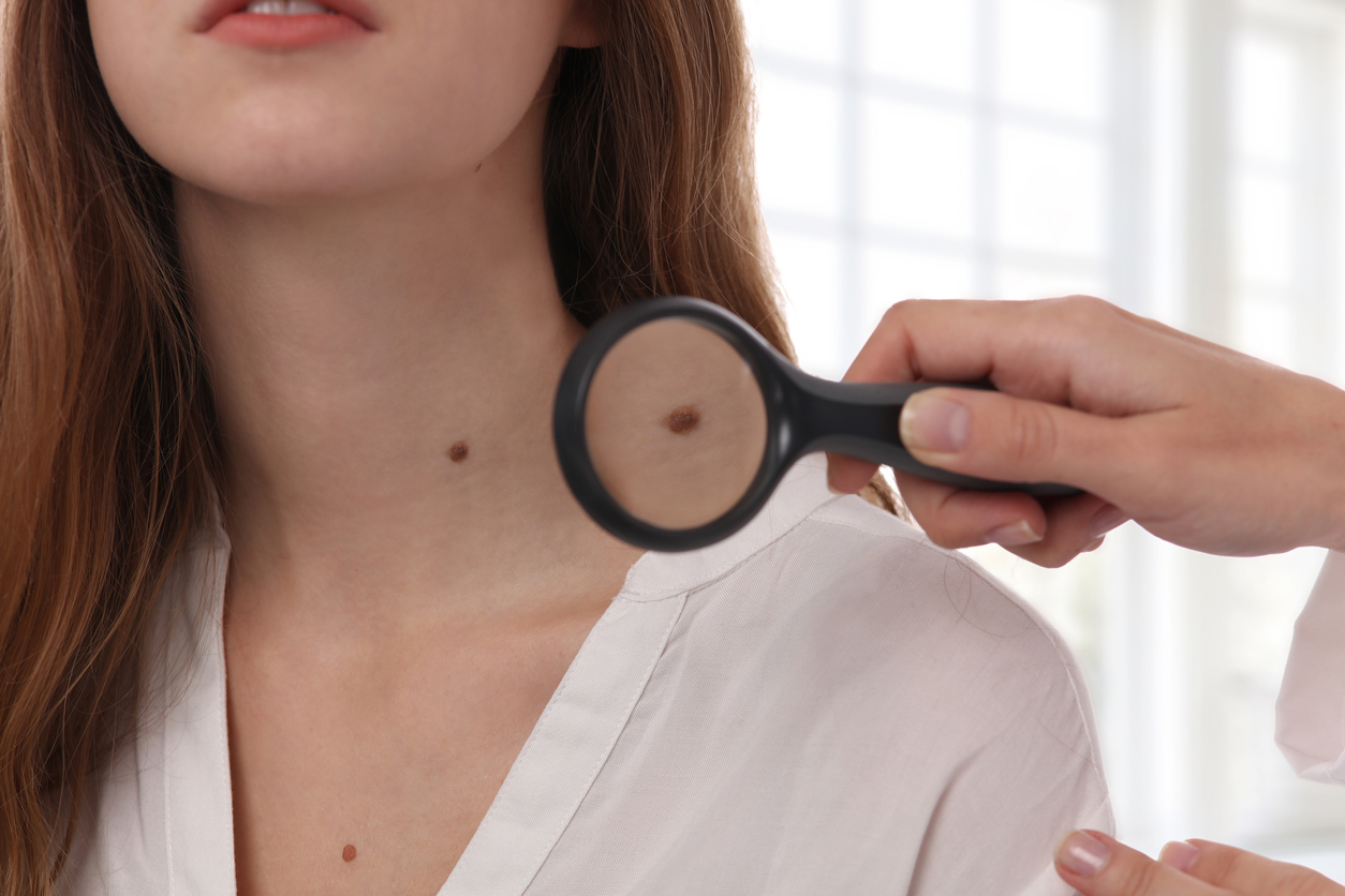 Prevenzione melanoma: come conoscere i propri nei