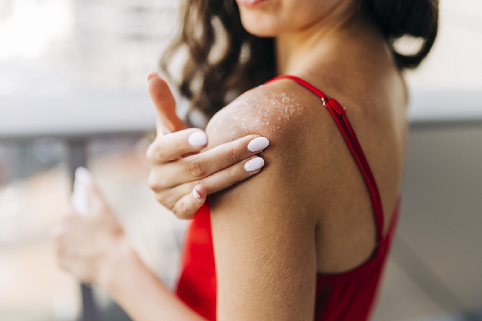 Eritema solare: cosa fare?