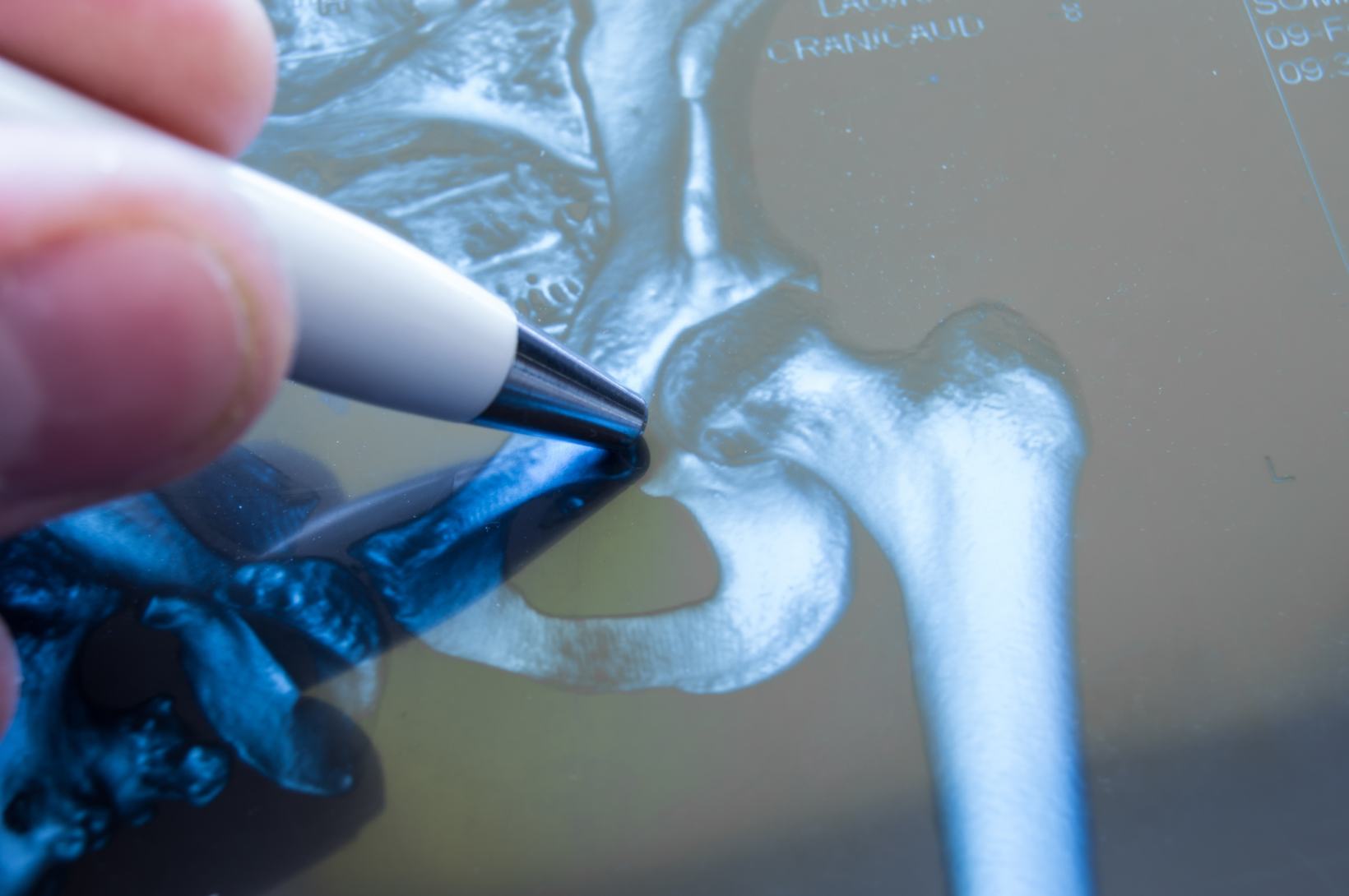 Protesi d’anca: una nuova tecnica chirurgica “made in USA” garantisce un maggior rispetto dell’anatomia del paziente e una maggior precisione dell’impianto